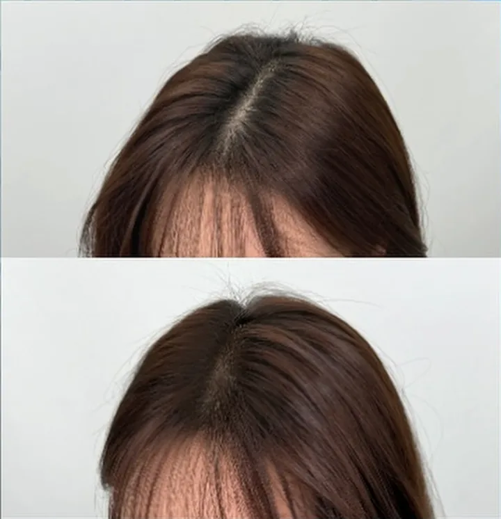여성 가르마 시술 전 · 후